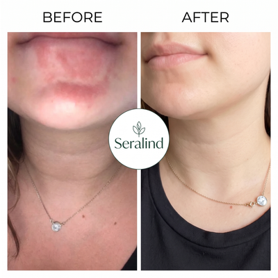 Seralind™ Anti-Spore Bar Soap